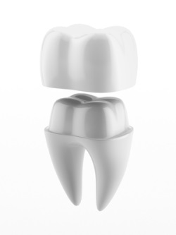 Cerec Same Day Crowns