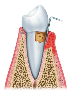 Periodontal Gum Disease