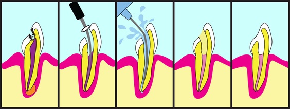 Endodonics